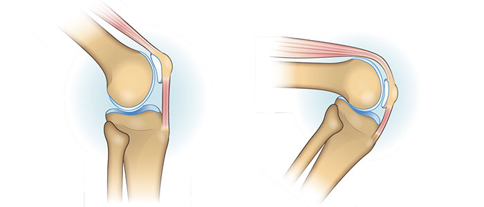 patellofemoral-knee-joint-feature-image