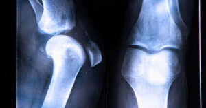 accurate diagnosis of osteo arthritis uses imaging